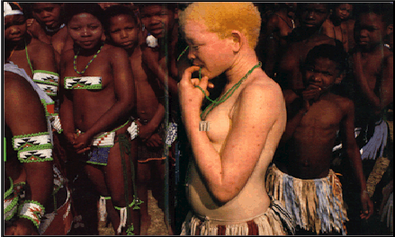 Albinos In Tanzania