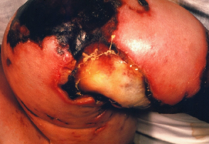 Meningococcemia